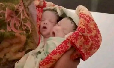 নওগাঁ প্রাইমল্যাব হাসপাতালে অদ্ভুত   দুই মাথাওয়ালা নবজাতকের জন্ম