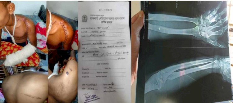 রাজশাহী মতিহারে কিশোর গ্যাংয়ের হামলায় আহত, যুবক মামলা তুলে  নিতে পরিবার কে হুমকি