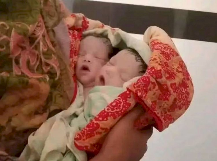 নওগাঁ প্রাইমল্যাব হাসপাতালে অদ্ভুত   দুই মাথাওয়ালা নবজাতকের জন্ম